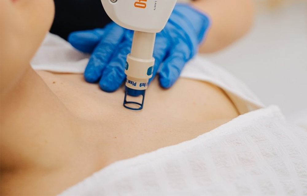4 - Fractional Laser στο Nτεκολτέ