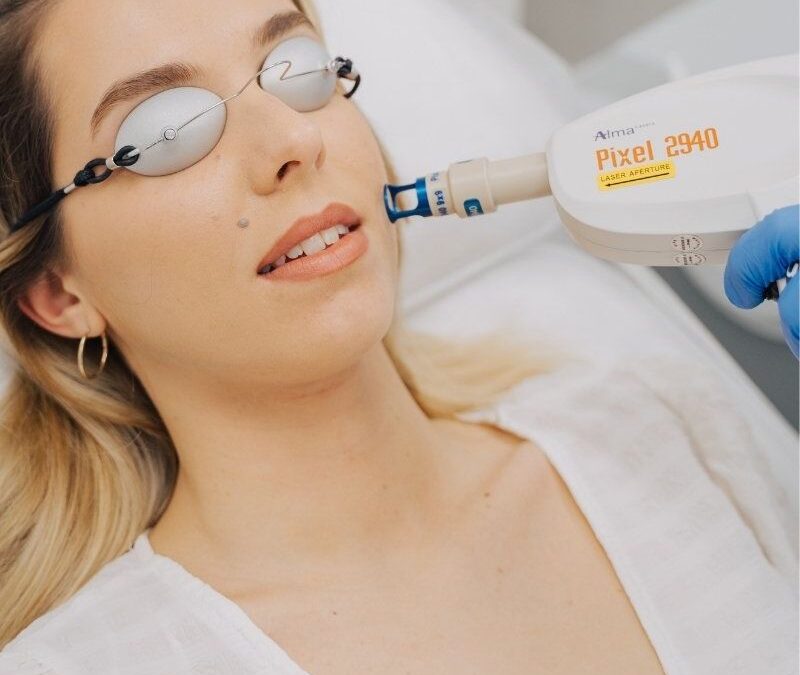 Fractional laser σε πρόωπο+λαιμό ή στο ντεκολτέ σε ειδική τιμή