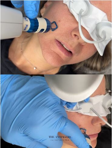 Fractional laser σε πρόωπο λαιμό ή στο ντεκολτέ